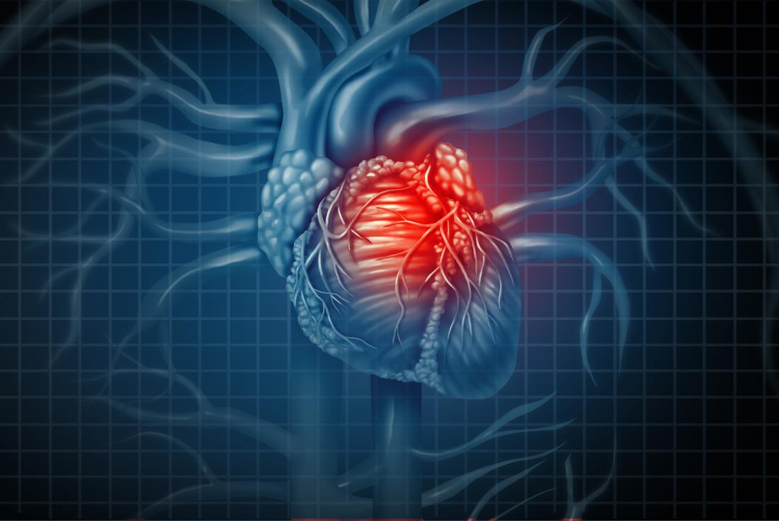 1100x736 Heart attack: New finding may change the face of treatment