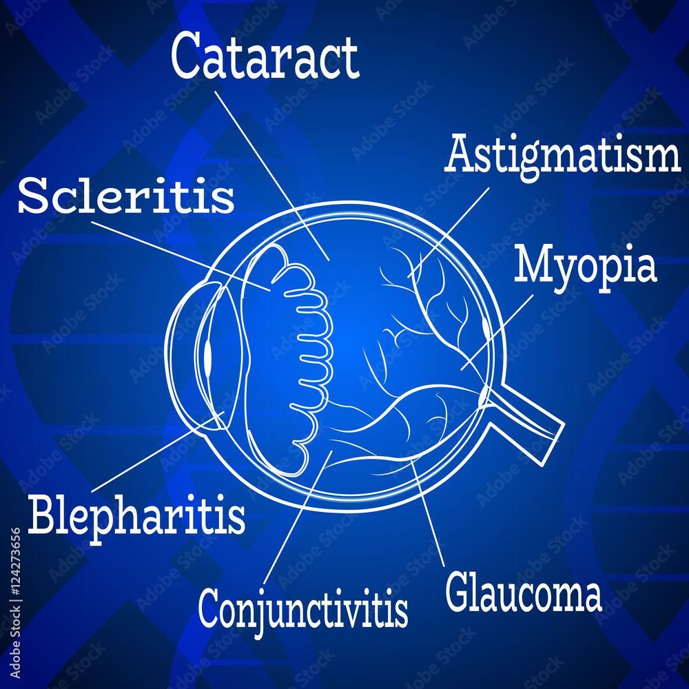 1000x1000 Human eye diseases anatomy structure.Medical infographics for ophthalmology clinic, vector illustration.List of ailments, astigmatism, myopia, glaucoma eye anatomy on dna chain blue wallpaper. Stock Vector