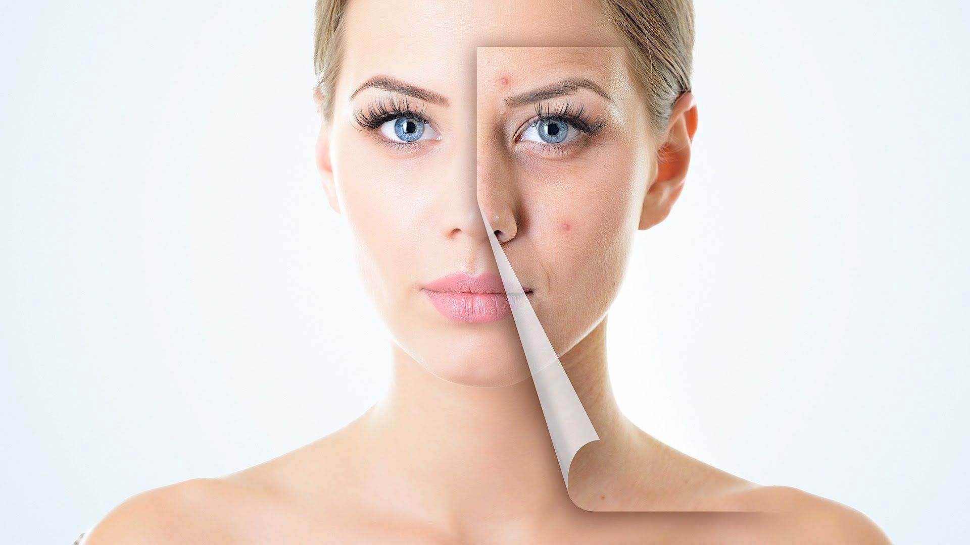 1920x1080 Skin Care Acne Scars Treatment