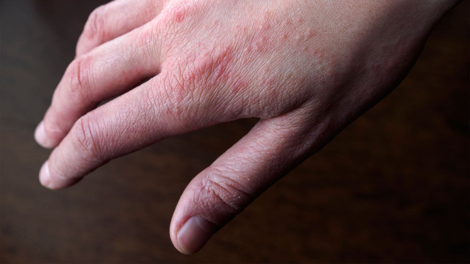 1600x900 Allergy & Immunology articles
