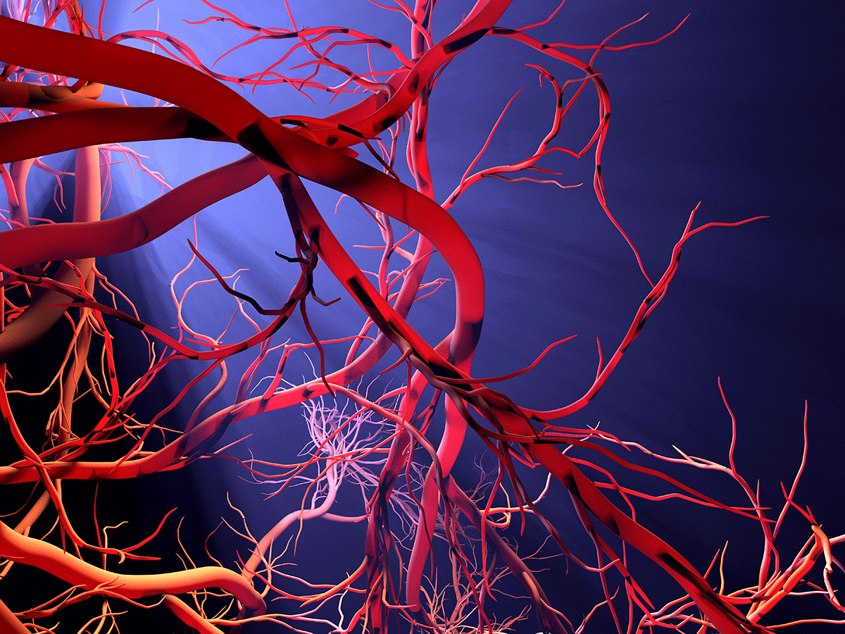 1200x900 Bioda's artificial blood vessel gains