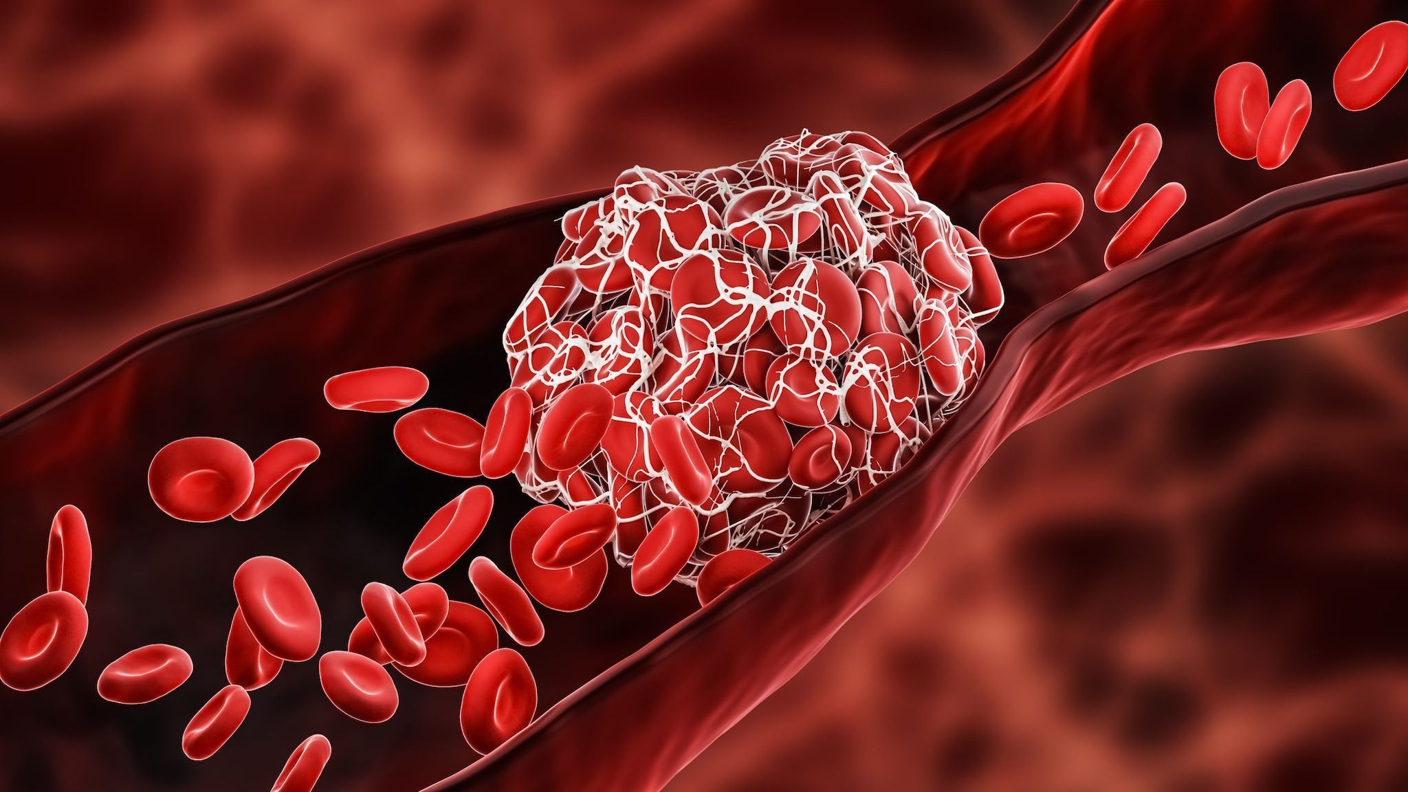 2048x1152 Blood Clots). Venous Thromboembolism