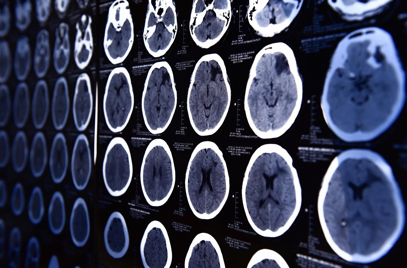 1621x1067 Tool Accelerates Analysis Of MRI Image
