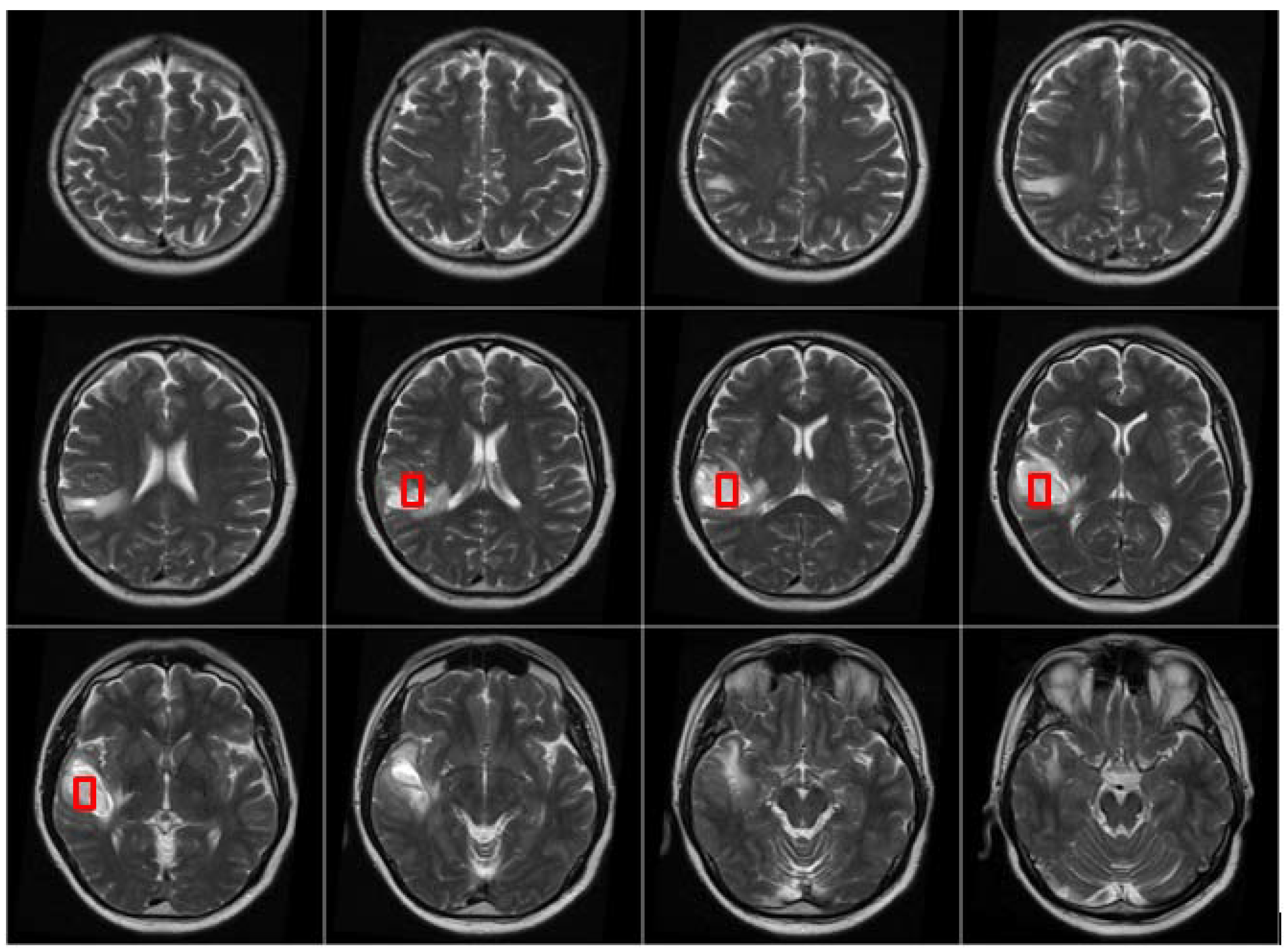 2800x2066 Segmentation of Brain Tumors in MRI