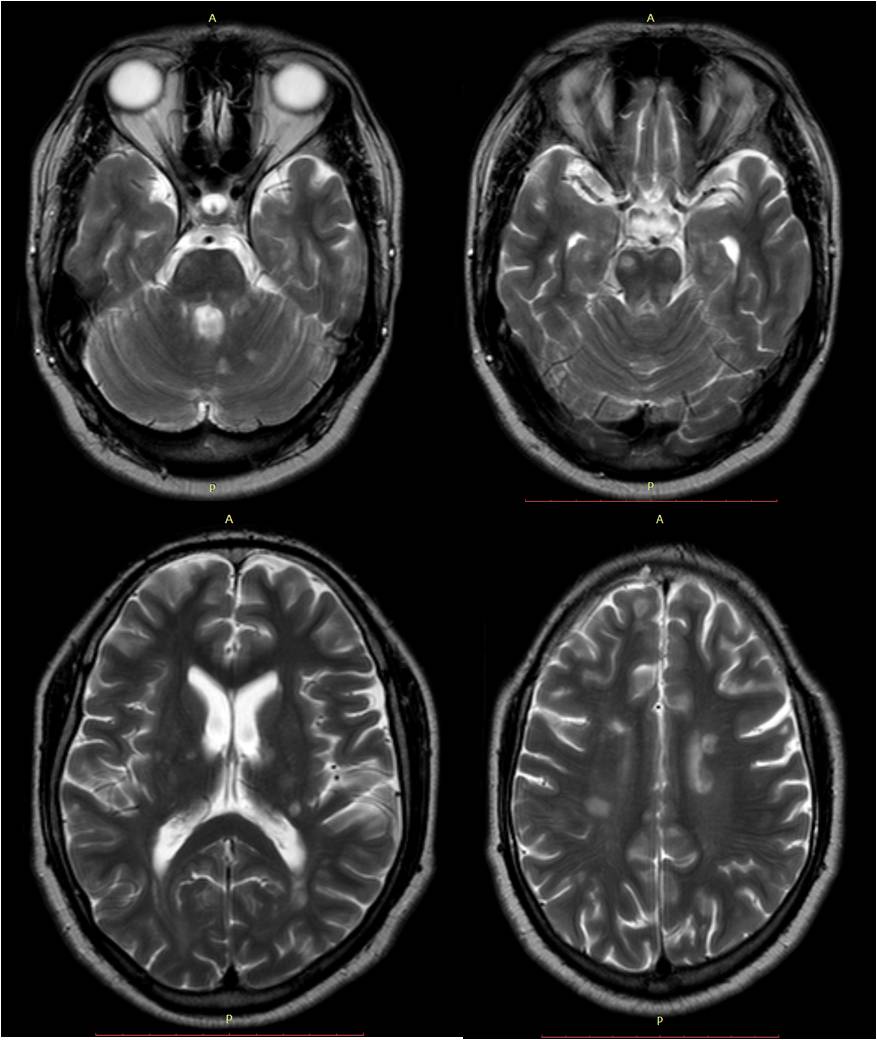 877x1040 Multiple Sclerosis
