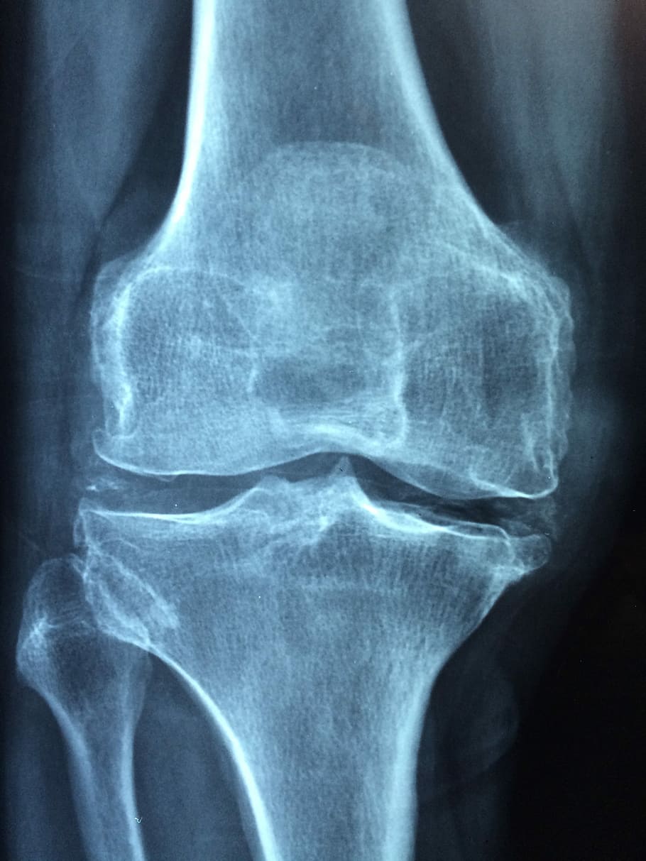 910x1213 HD Wallpaper: X Ray Results On Bone, Knee, Old, Care, Injury, Pain