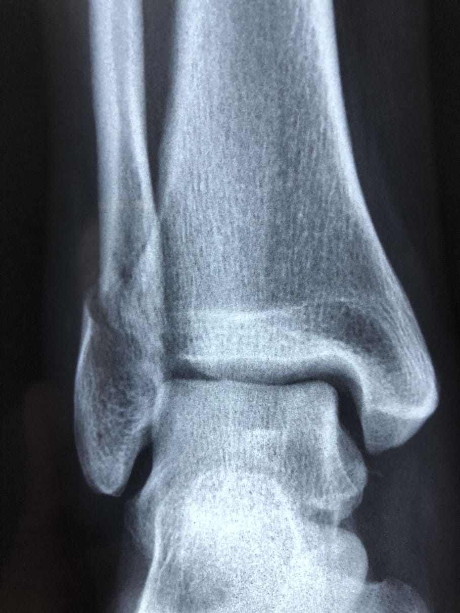 910x1213 HD Wallpaper: Bone X Ray Result, Radiography, Diagnosis, Anatomy