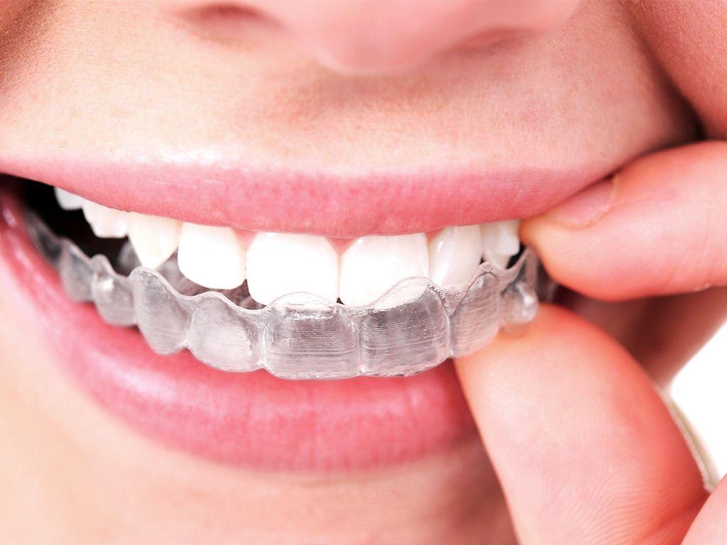1024x768 Smile Direct Club vs. Invisalign: Is There a Clear Winner