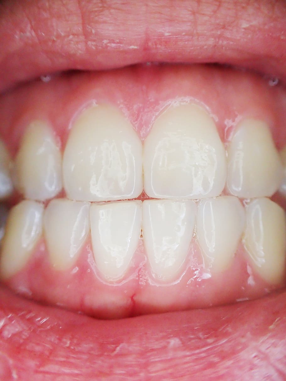 910x1213 HD wallpaper: closeup photo of person's teeth, mouth, dental