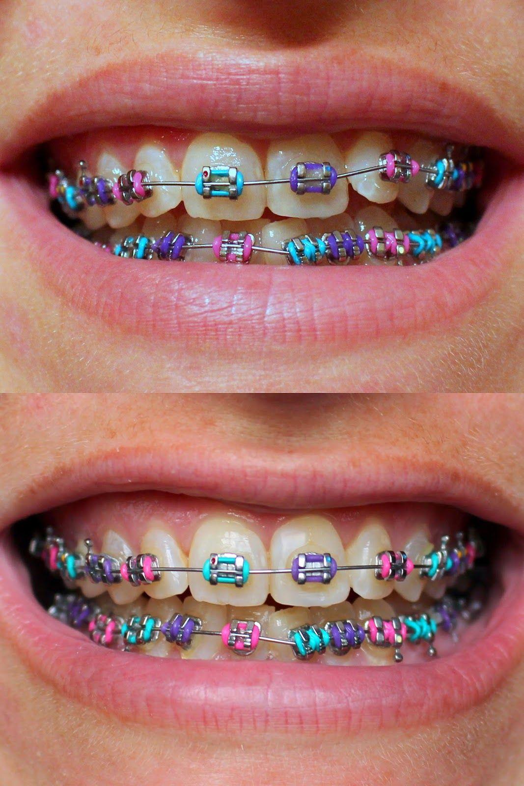 1067x1600 Braces Colors