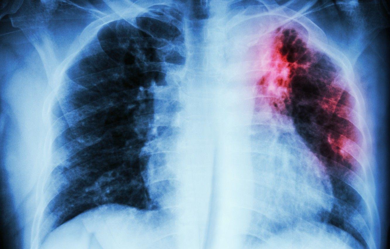 1332x850 Wallpaper stain, disease, lungs, radiography, infection image for desktop, section текстуры