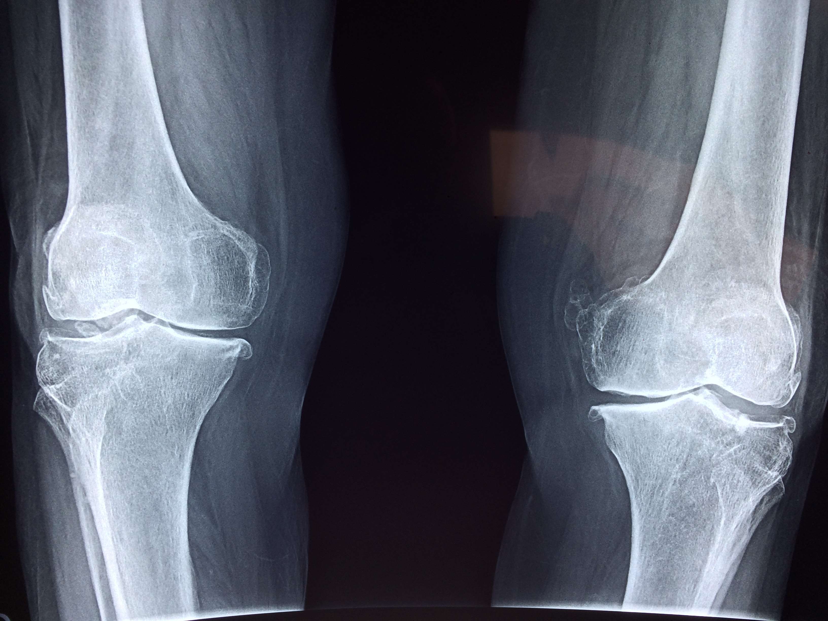 3264x2448 anatomy, bone, cartilage, disease, health, hospital, illness, injury, joint, knee, medical, orthopedic, patient, skeleton, therapist, treatment, x ray wallpaper. Mocah.org HD Desktop Wallpaper