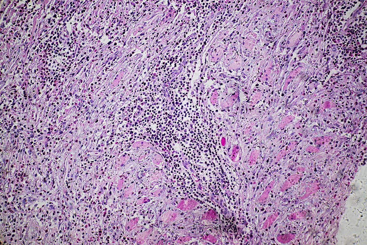 1200x800 Eosinophilic granuloma of human