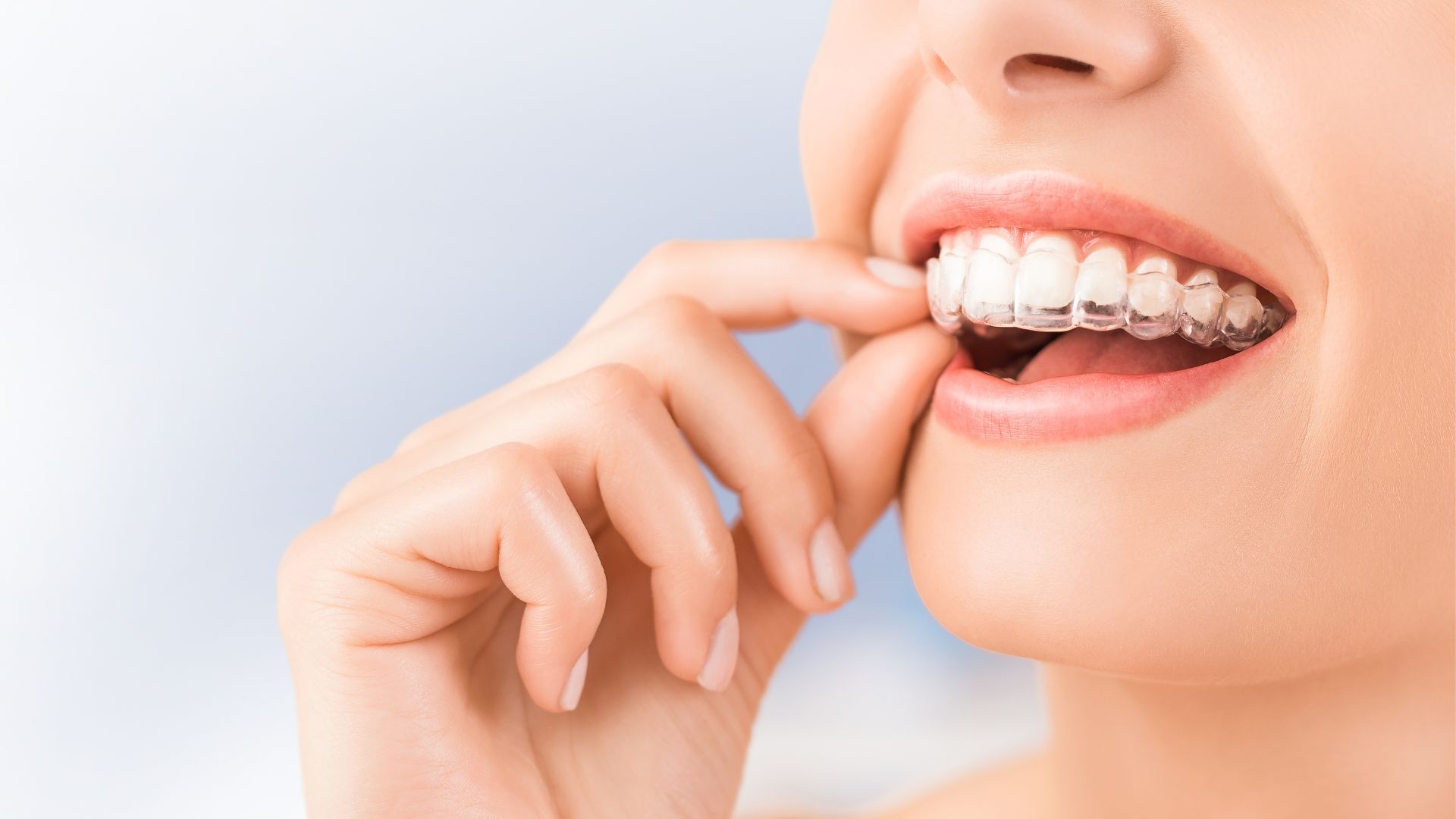 1920x1080 The Benefits of Invisalign Treatment at Paget Dental