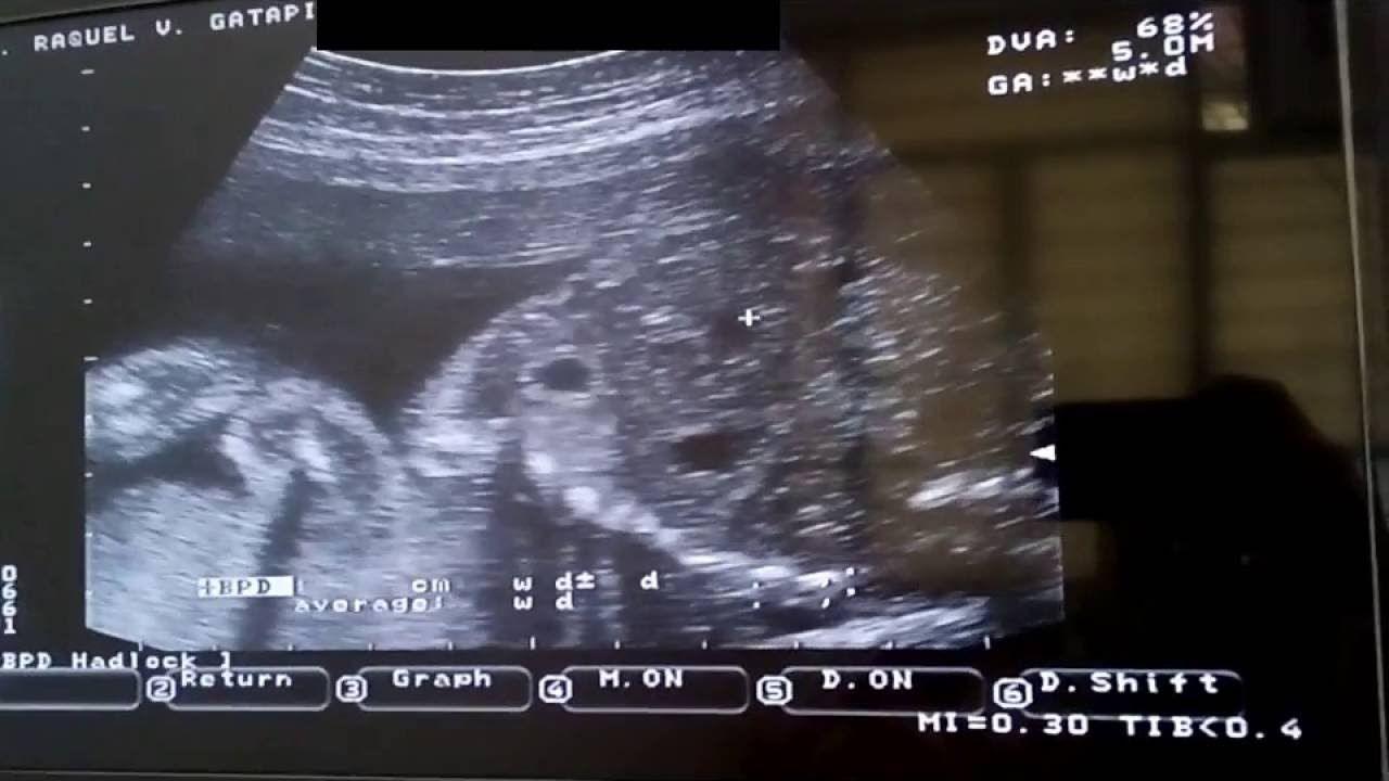 1280x720 month old or 23 weeks ultrasound. Baby ultrasound, 5 month baby, Ultrasound