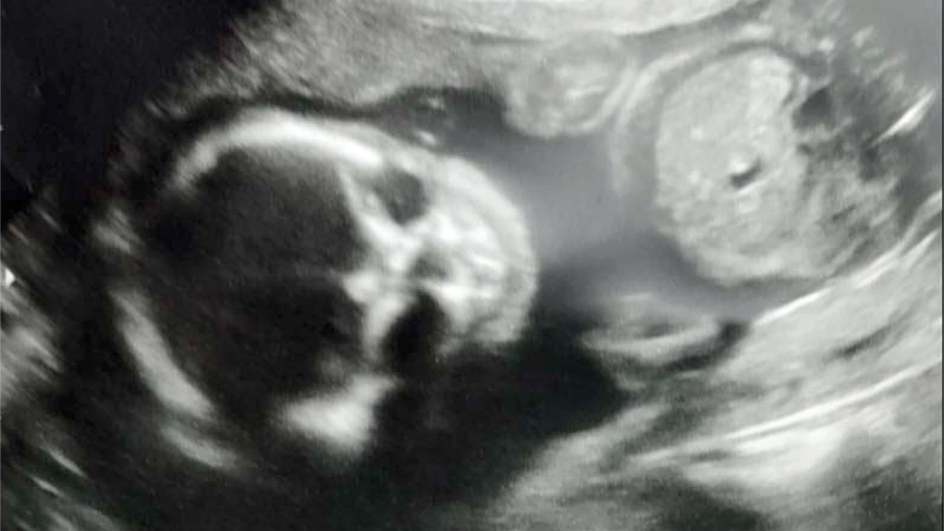 1920x1080 Pregnant Oklahoma Mom 'Freaked Out' When Ultrasound Showed a Skeleton in Her Belly