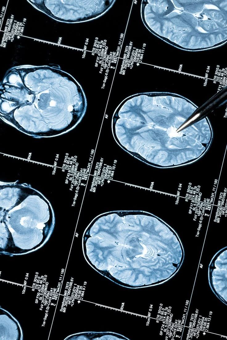 736x1104 Neurology aesthetic wallpaper. Neuroscience research aesthetic, Neuropsychology, Epilepsy awareness month