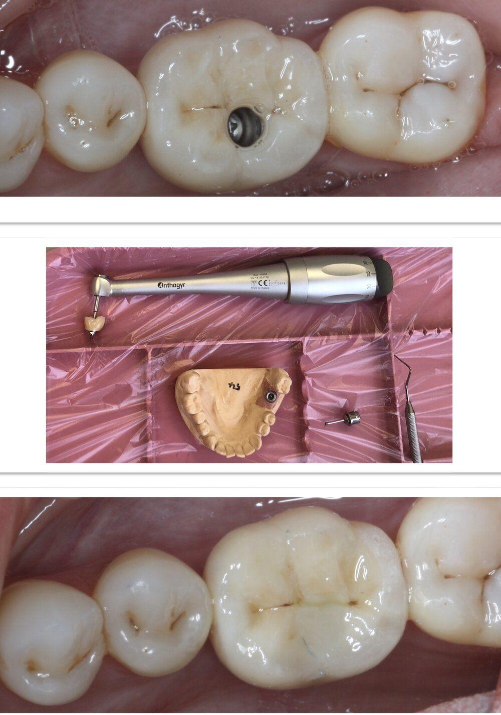 1000x1427 Dental Implants. Brisbane. Spring .brisbanesmileboutique.com.au