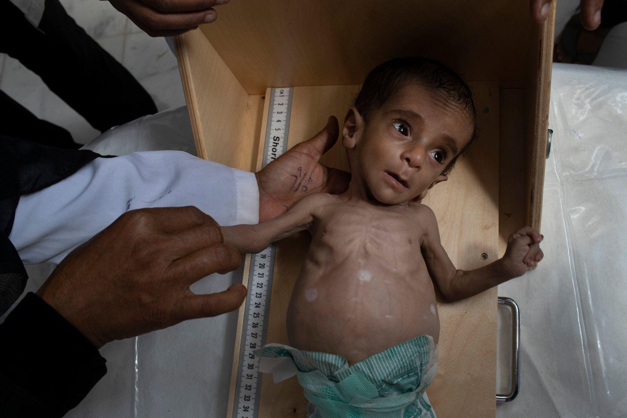 2048x1365 Why We Are Publishing Haunting Photo of Emaciated Yemeni Children
