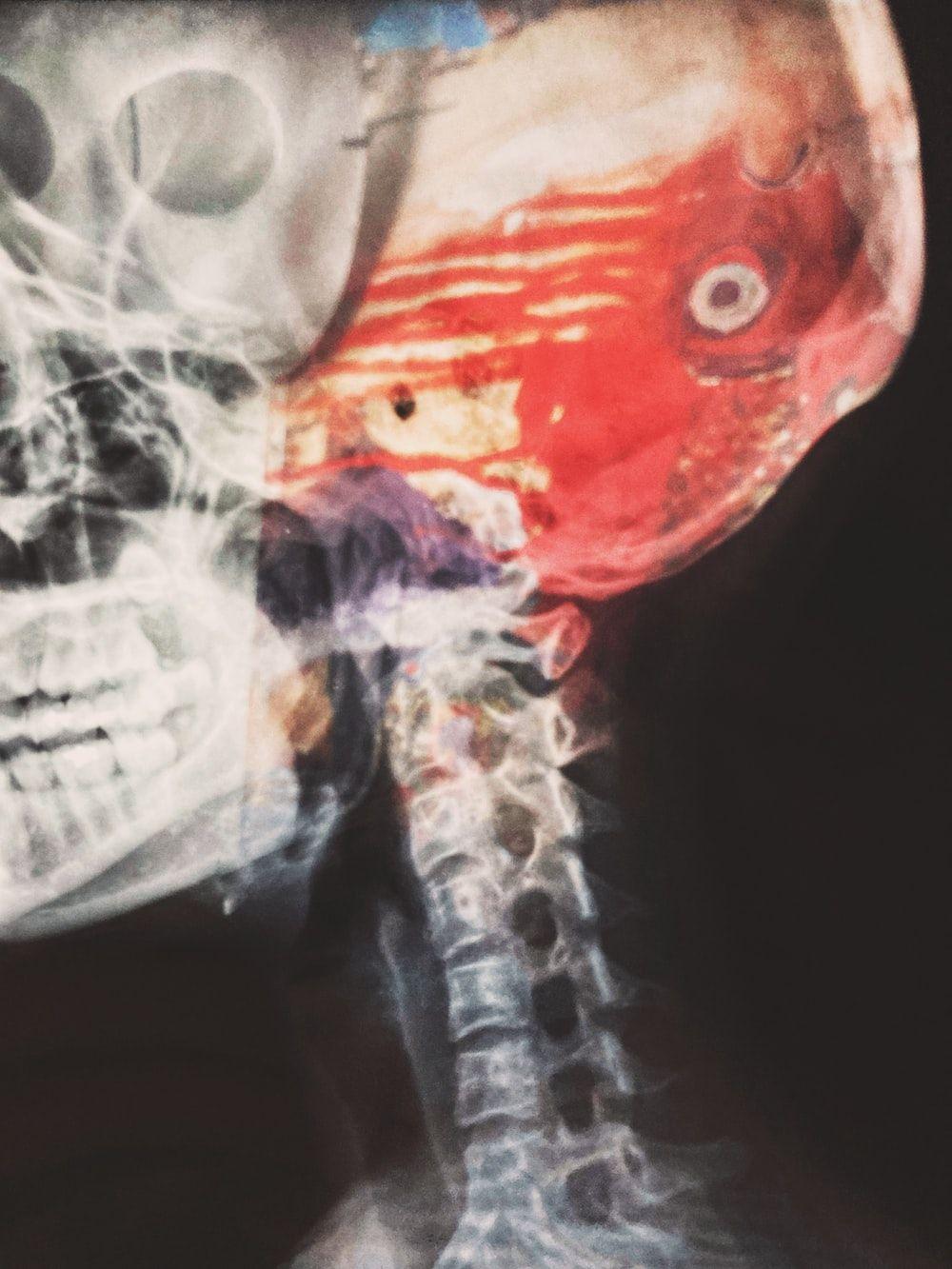 1000x1333 X Ray Picture. Download Free Image