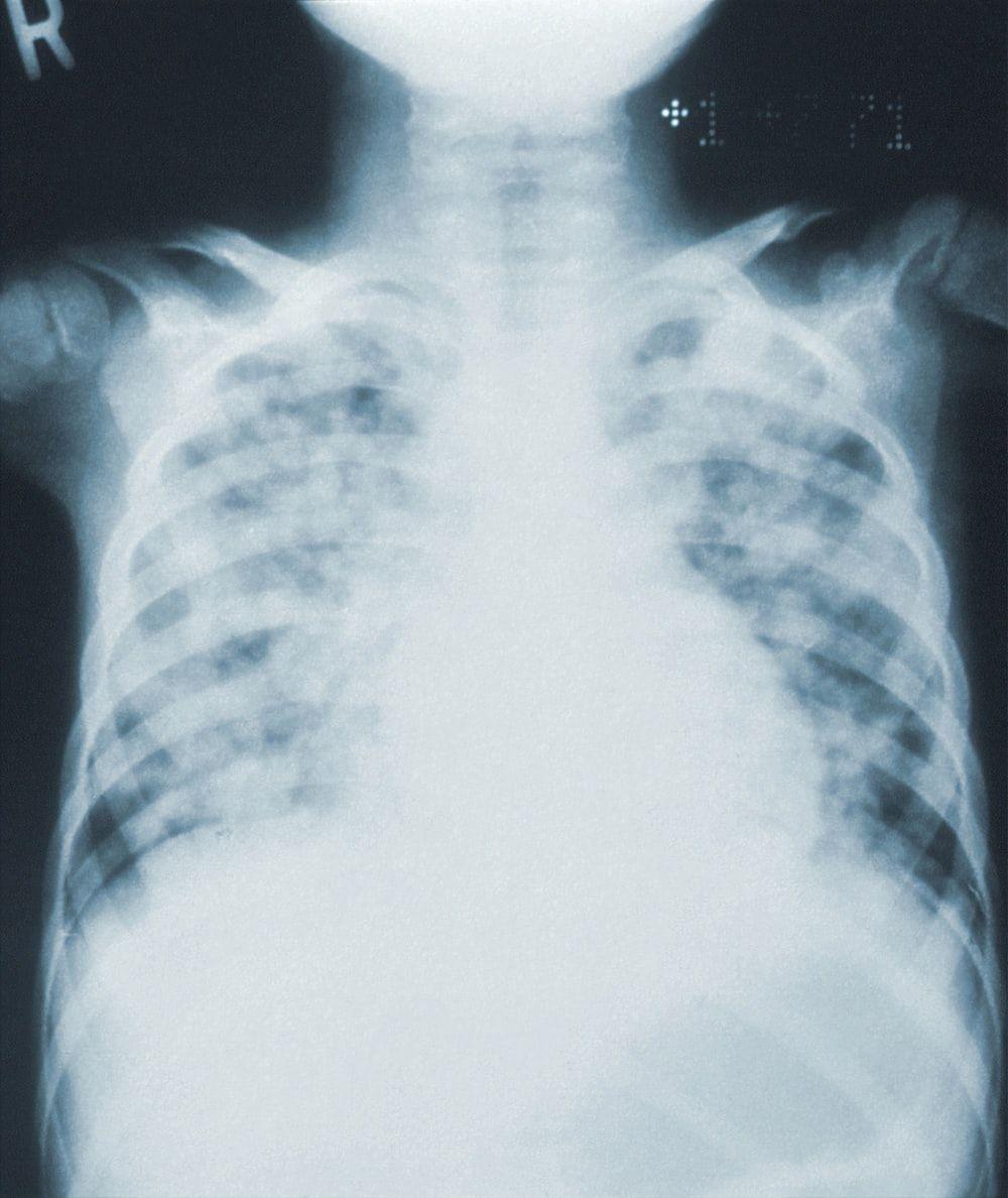 1000x1188 X Ray Picture. Download Free Image