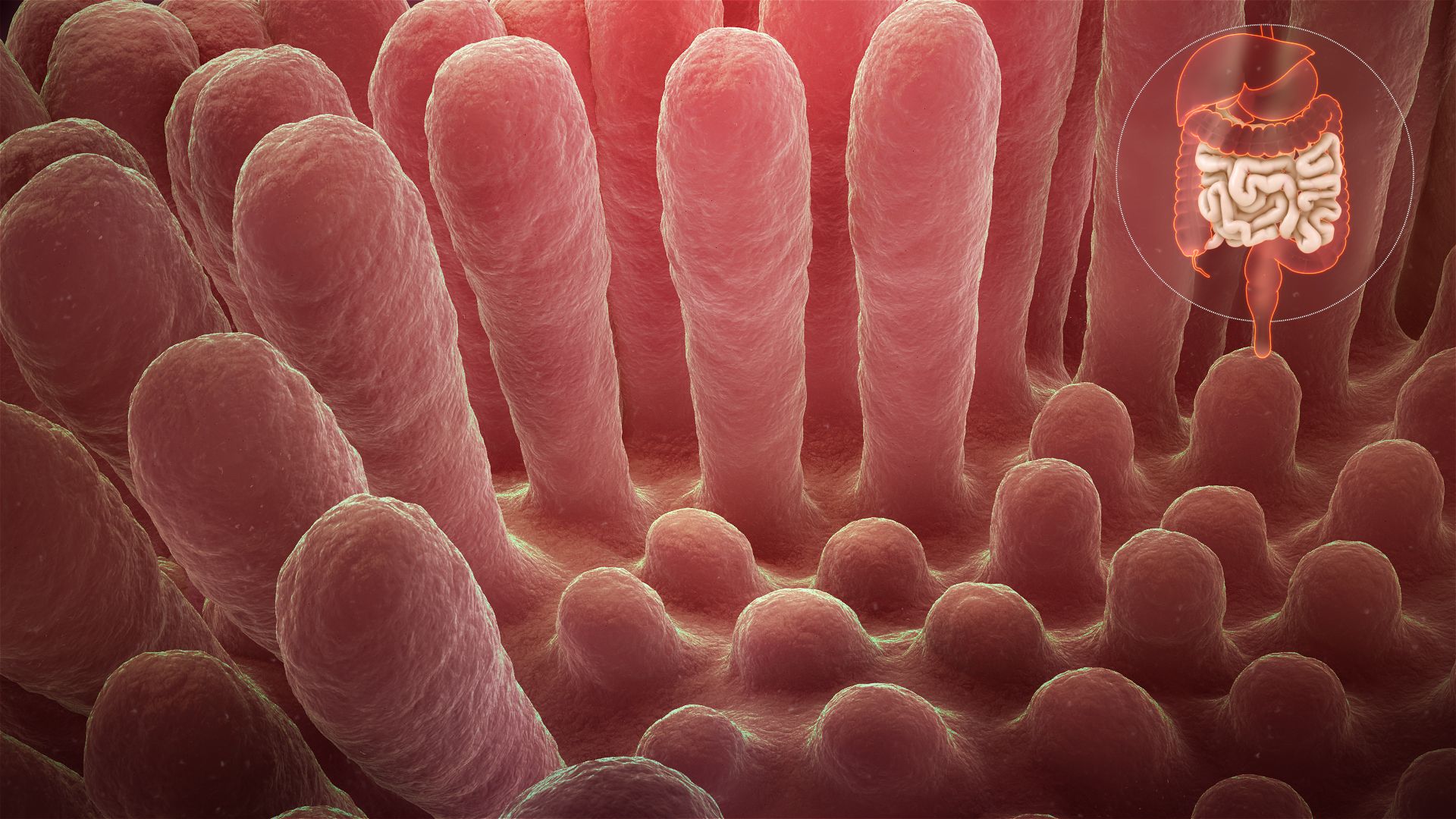 1920x1080 Inflammed mucous layer of the intestinal villi depicting Celiac
