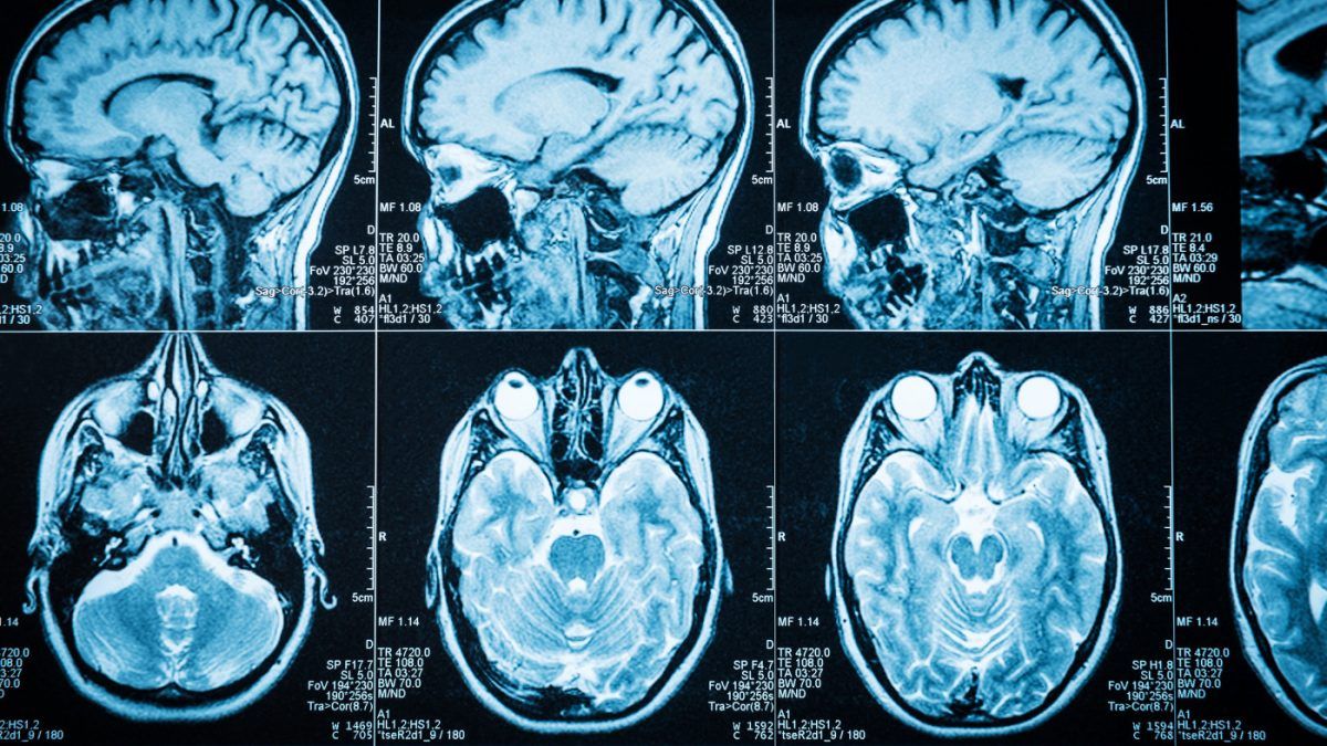 1200x675 3D Imaging of MS Brain Lesions May ID Those Most Likely to Heal, Guiding Treatment