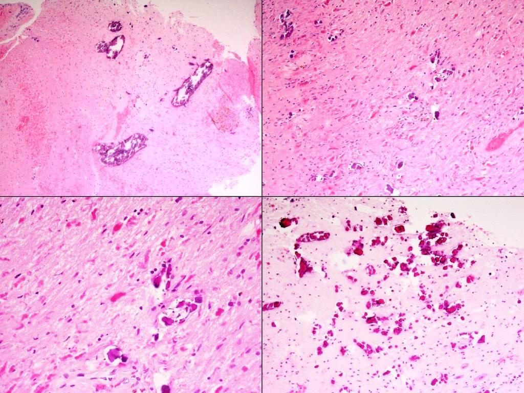 1024x768 Leukoencephalopathy with calcifications and cysts (histology)