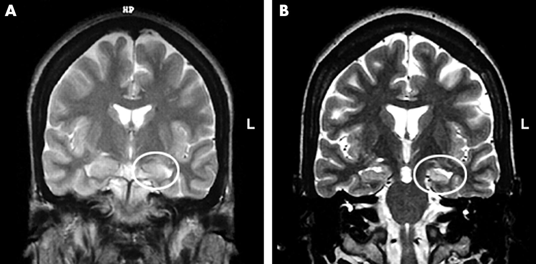1800x887 Abnormal Brain Mri T2