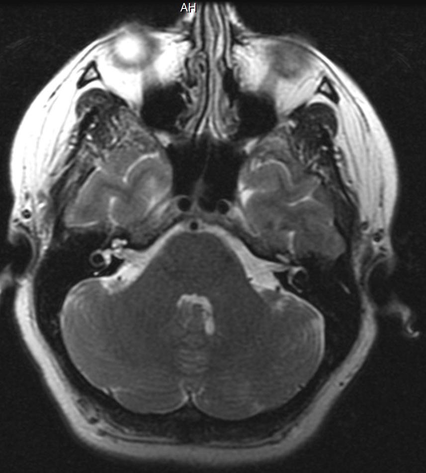 857x950 Vermis Mri