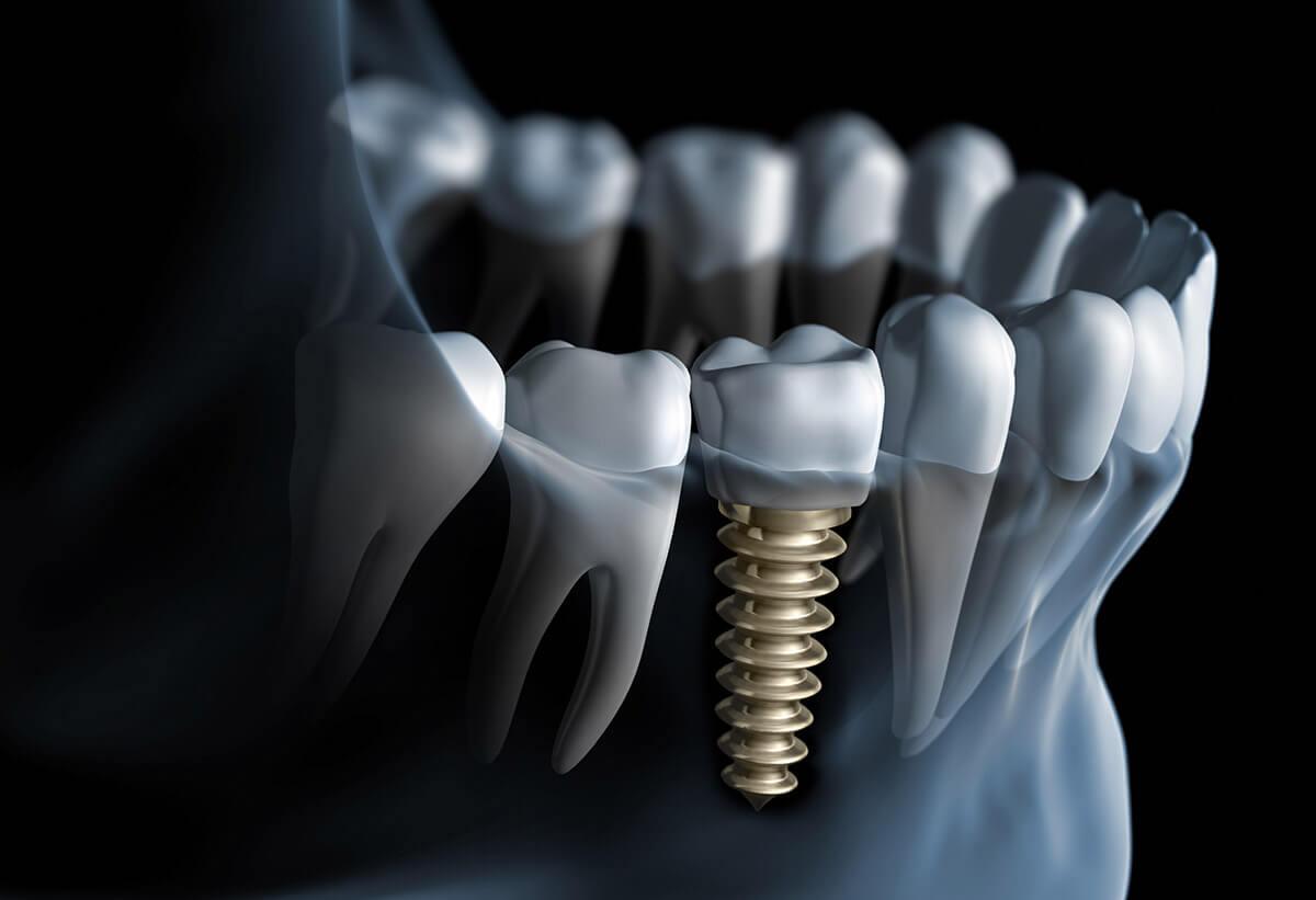 1200x821 Are Dental Implants Safe You Should Know