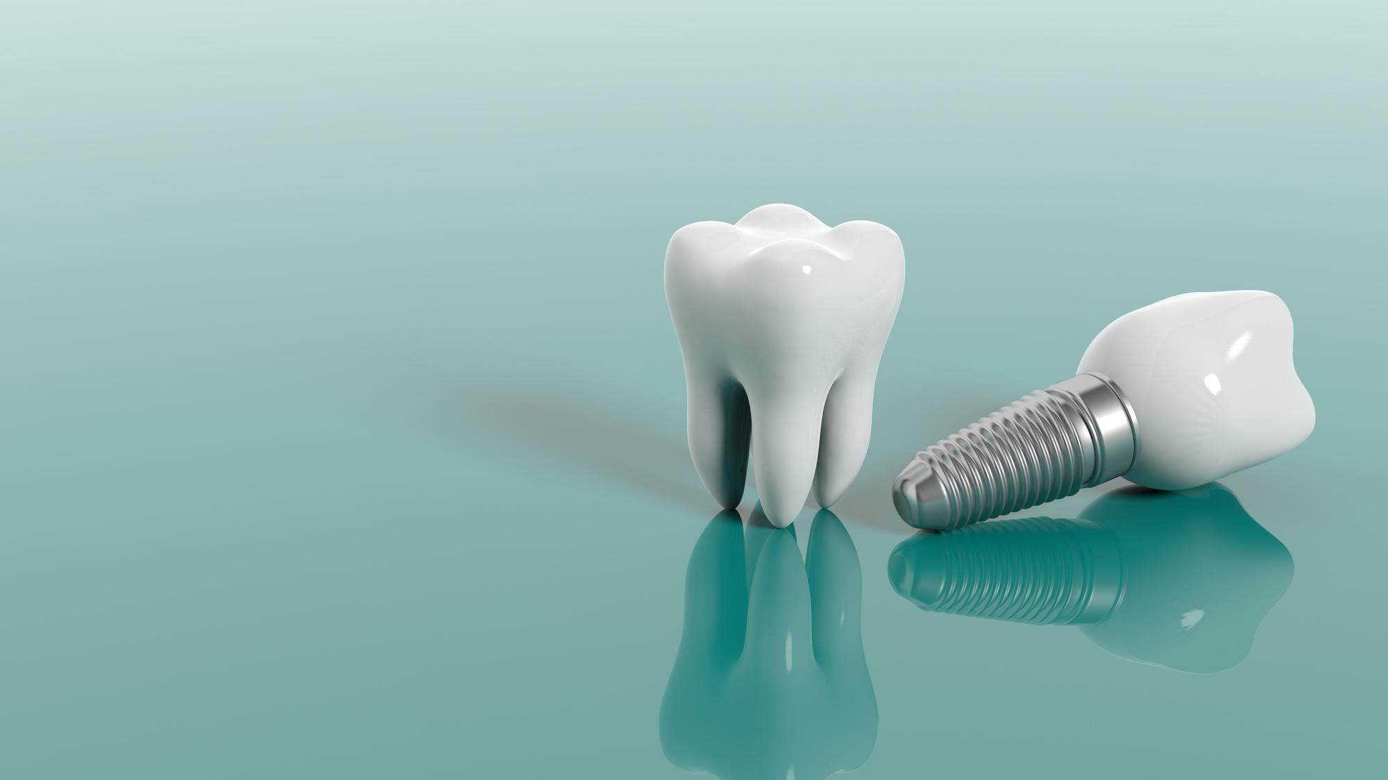 Dental Implant Wallpapers - Top Free Dental Implant Backgrounds