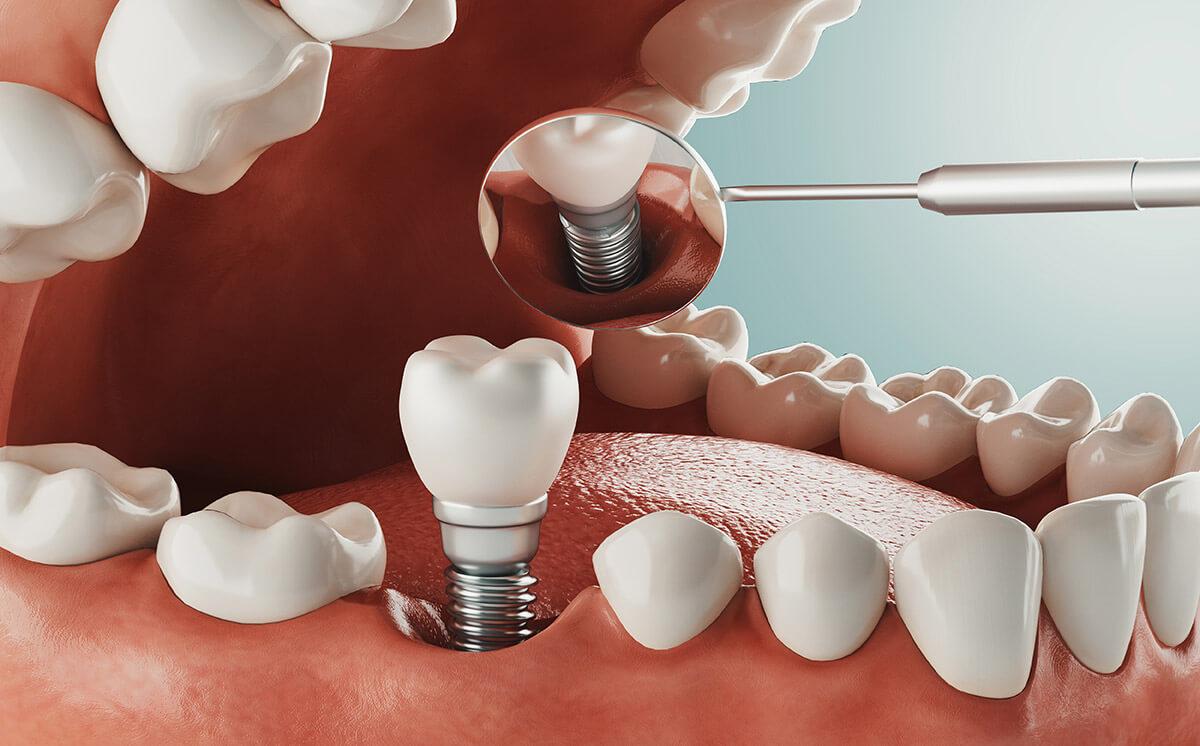 Detailed How Much Does It Cost To Get Teeth Implants Scene Concept Detailed How Much Does It Cost To Get Teeth Implants Scene Concept