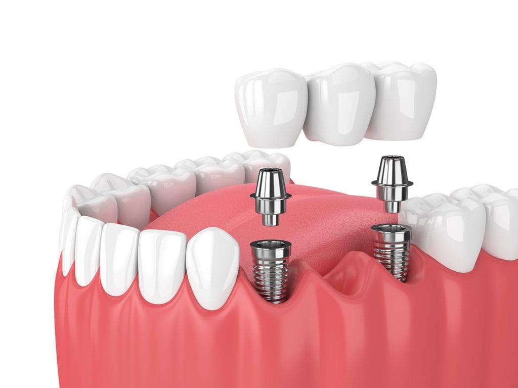 Dental Implant Wallpapers - Top Free Dental Implant Backgrounds