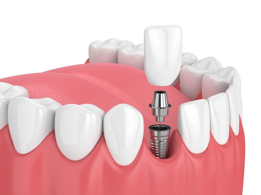 Dental Implant Wallpapers - Top Free Dental Implant Backgrounds