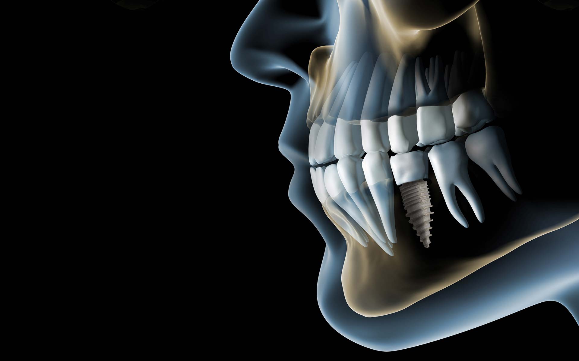 Dental Implant Wallpapers - Top Free Dental Implant Backgrounds