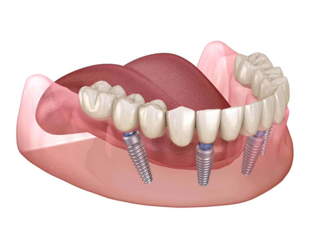 Dental Implant Wallpapers - Top Free Dental Implant Backgrounds