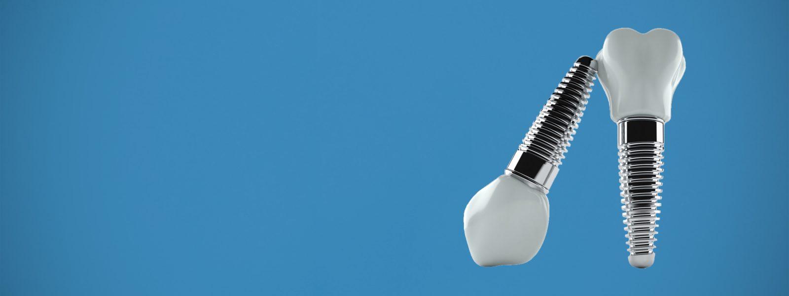 Gorgeous Best Place To Get Dental Implants Photo Art Gorgeous Best Place To Get Dental Implants Photo Art