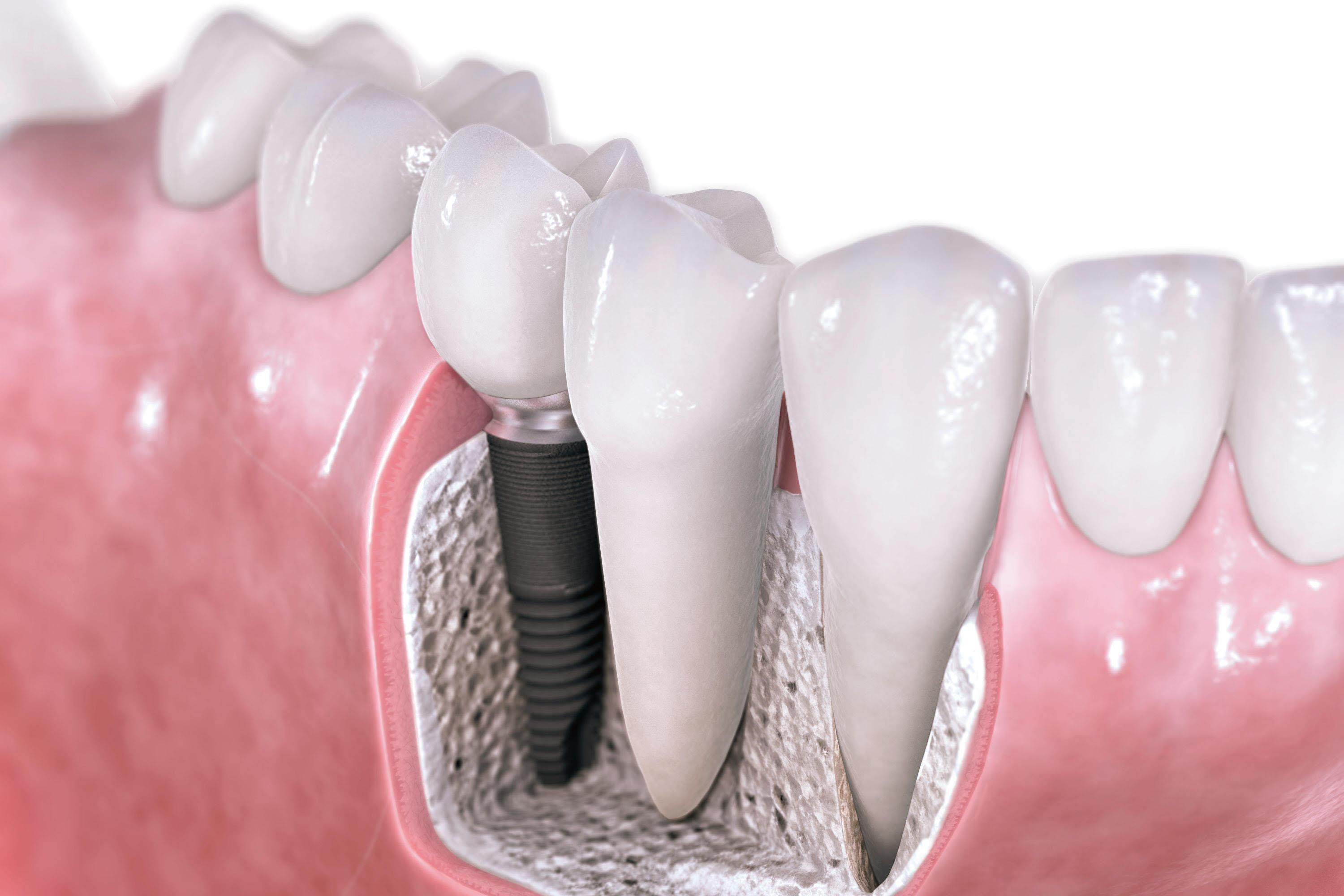 Lush Best Place To Get Dental Implants View in HD Lush Best Place To Get Dental Implants View in HD