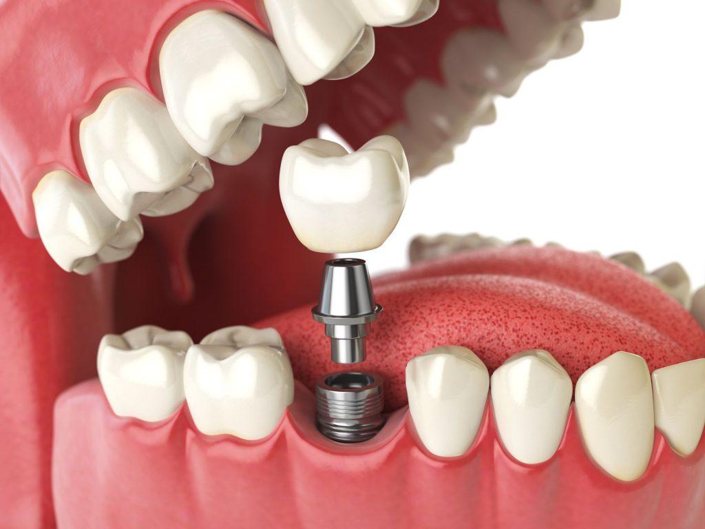 1024x768 The of History of Dental Implants
