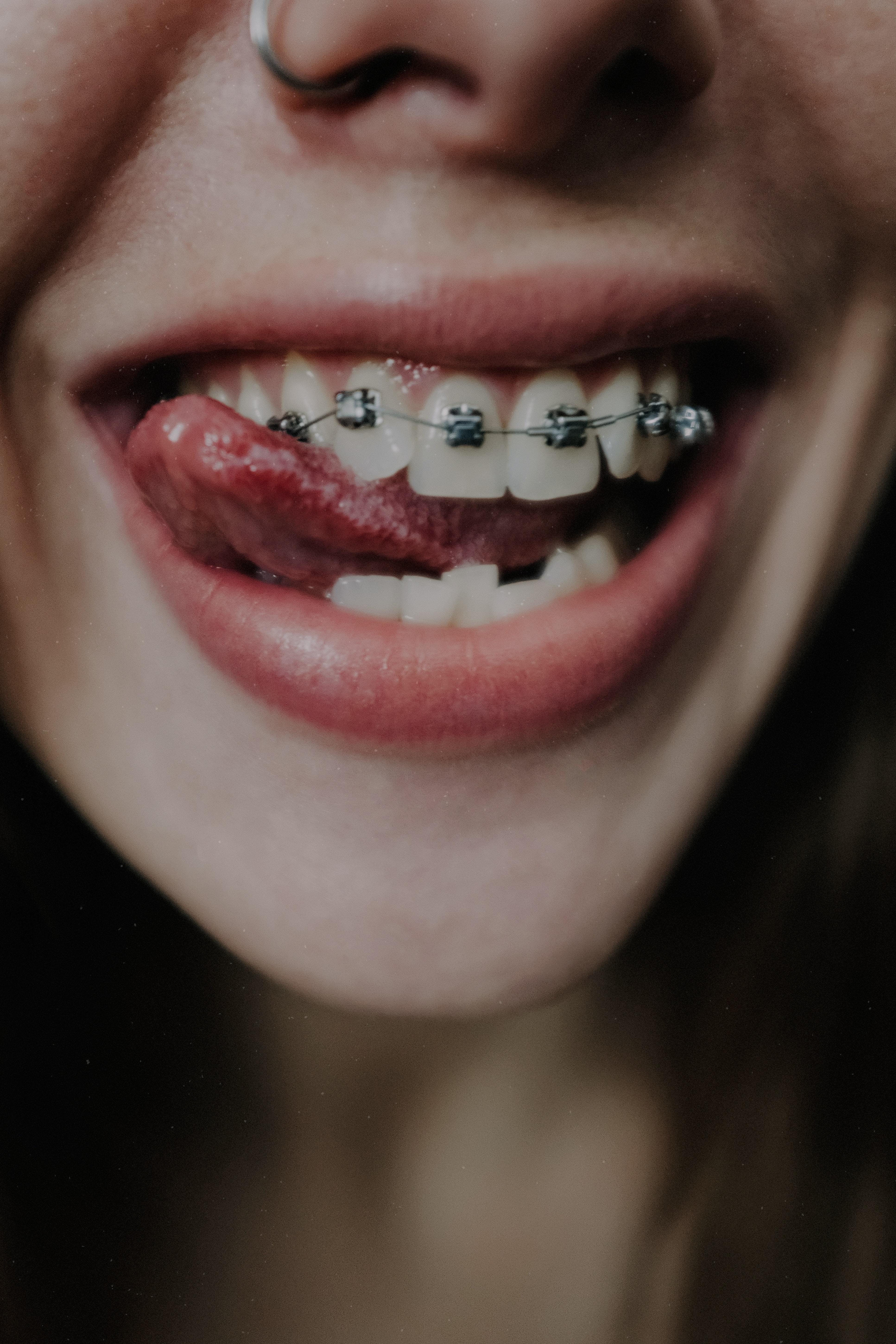 3867x5800 Crop coquettish smiling woman with teeth braces · Free