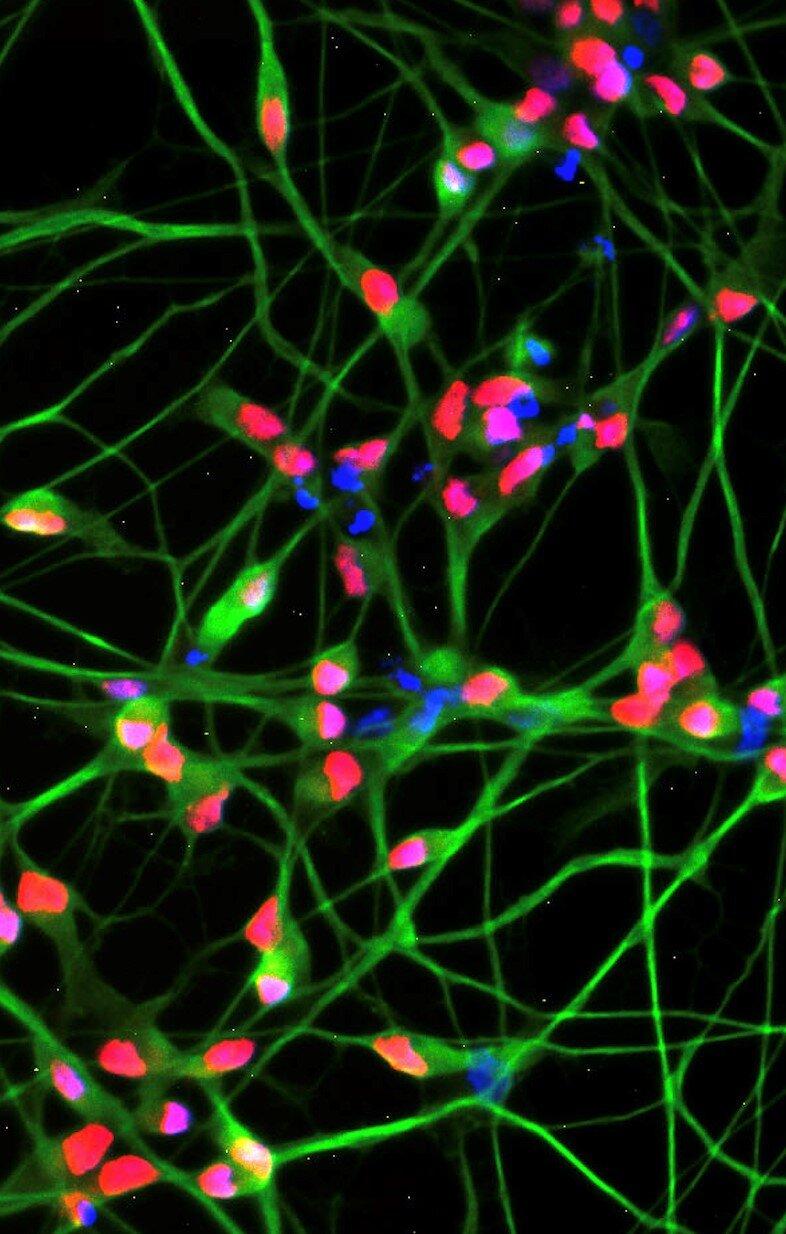 786x1234 Study adds evidence that altered fat metabolism, enzyme, plays key role in Lou Gehrig's disease