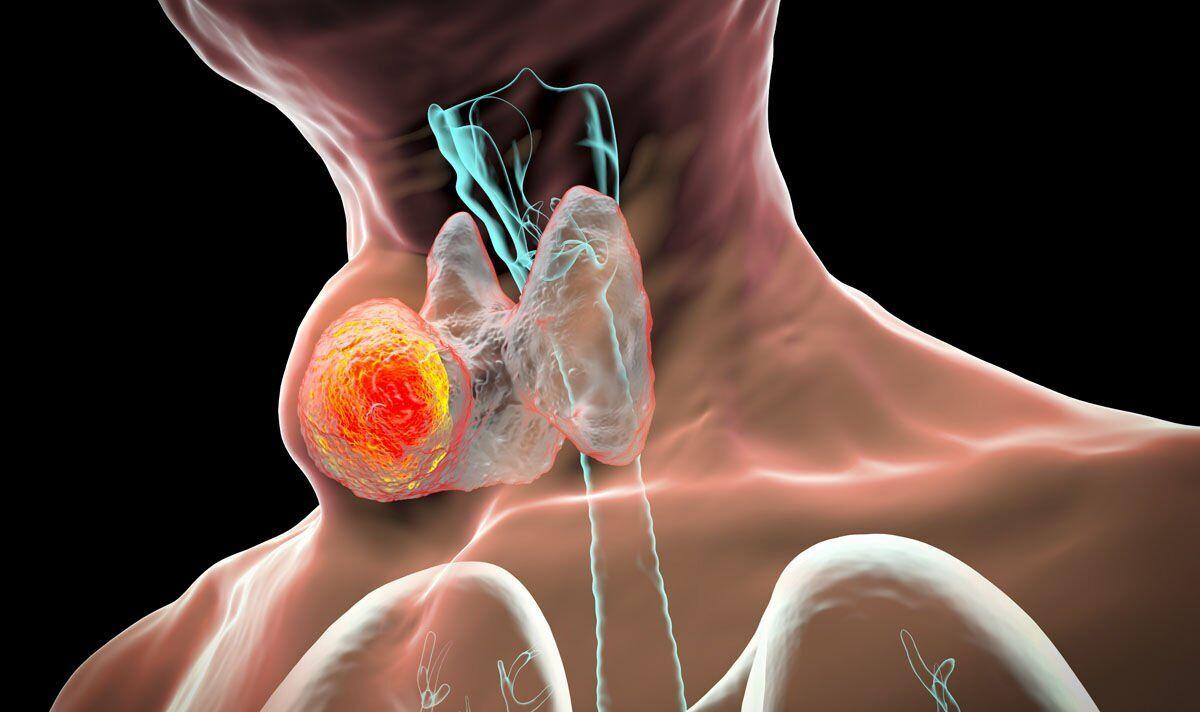 1200x712 Hypothyroidism: Slow speech and low voice could signal nerves are struggling to perform. Express.co.uk