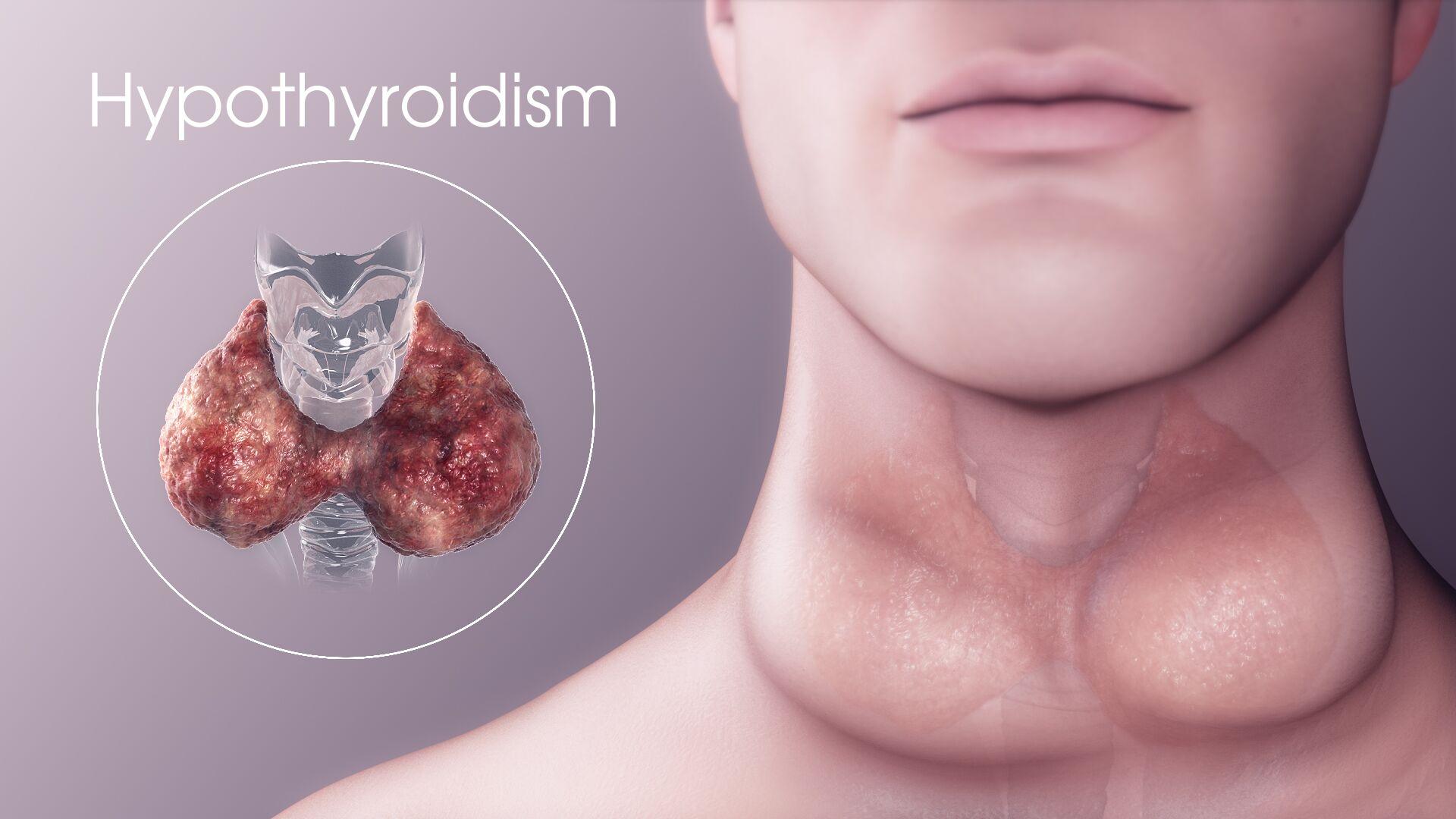 1920x1080 Hypothyroidism: Causes, Symptoms, Diagnosis and Treatment