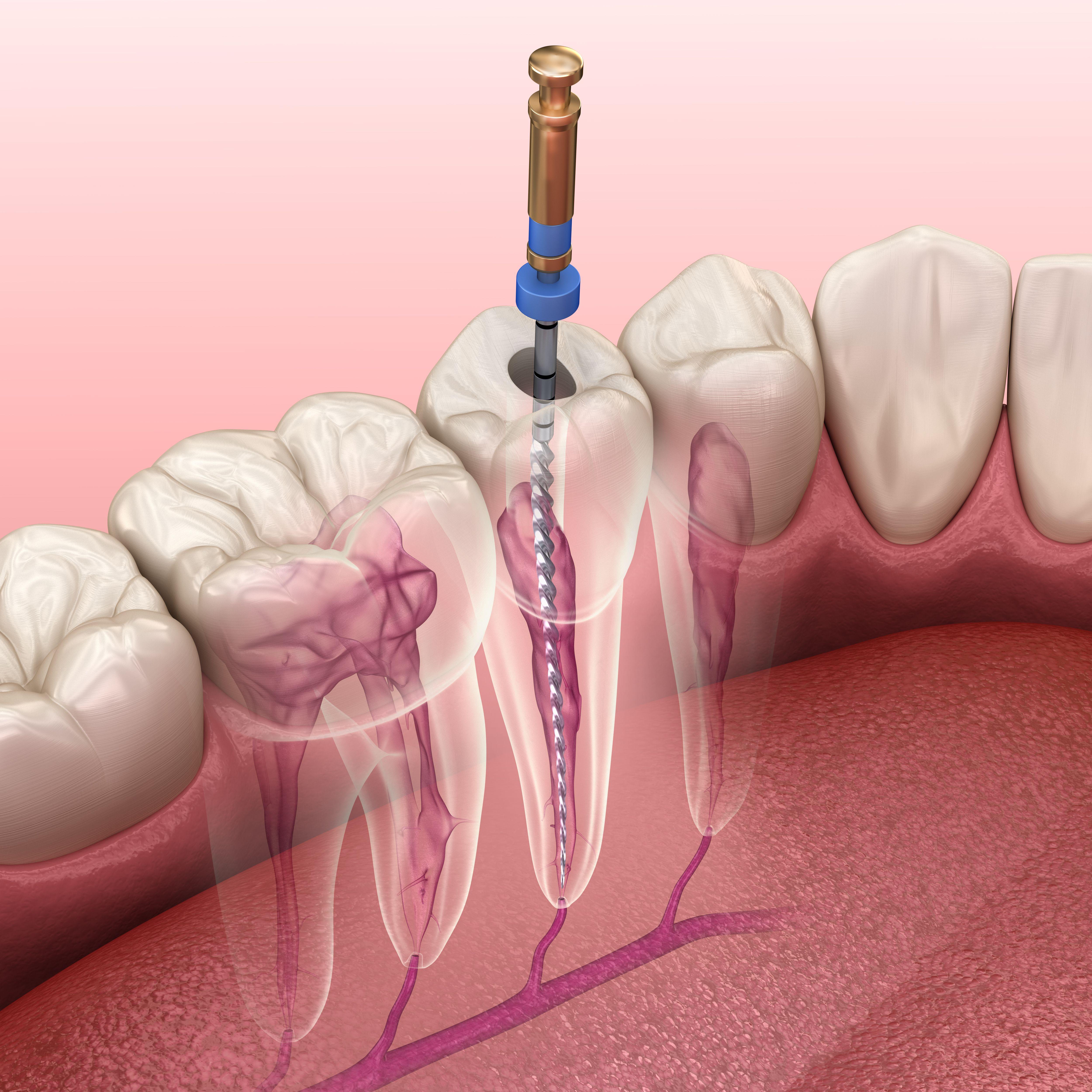 Dynamic Can I Go To Work After A Root Canal Moment in HD Dynamic Can I Go To Work After A Root Canal Moment in HD