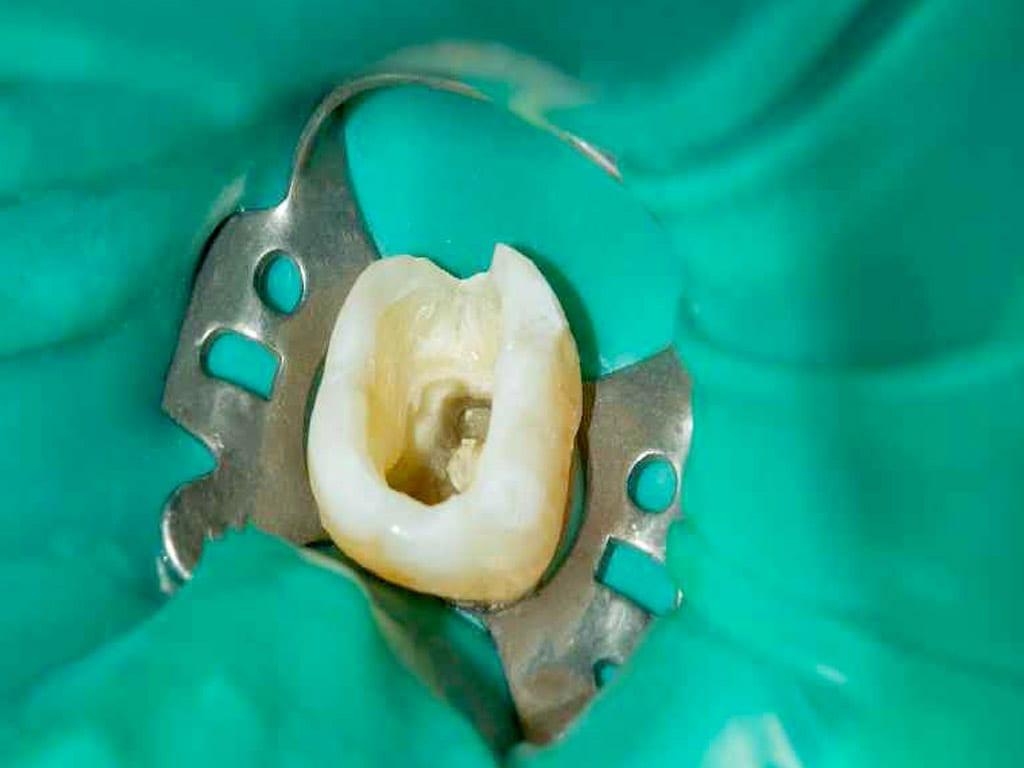 Root Canal Treatment Wallpapers - Top Free Root Canal Treatment