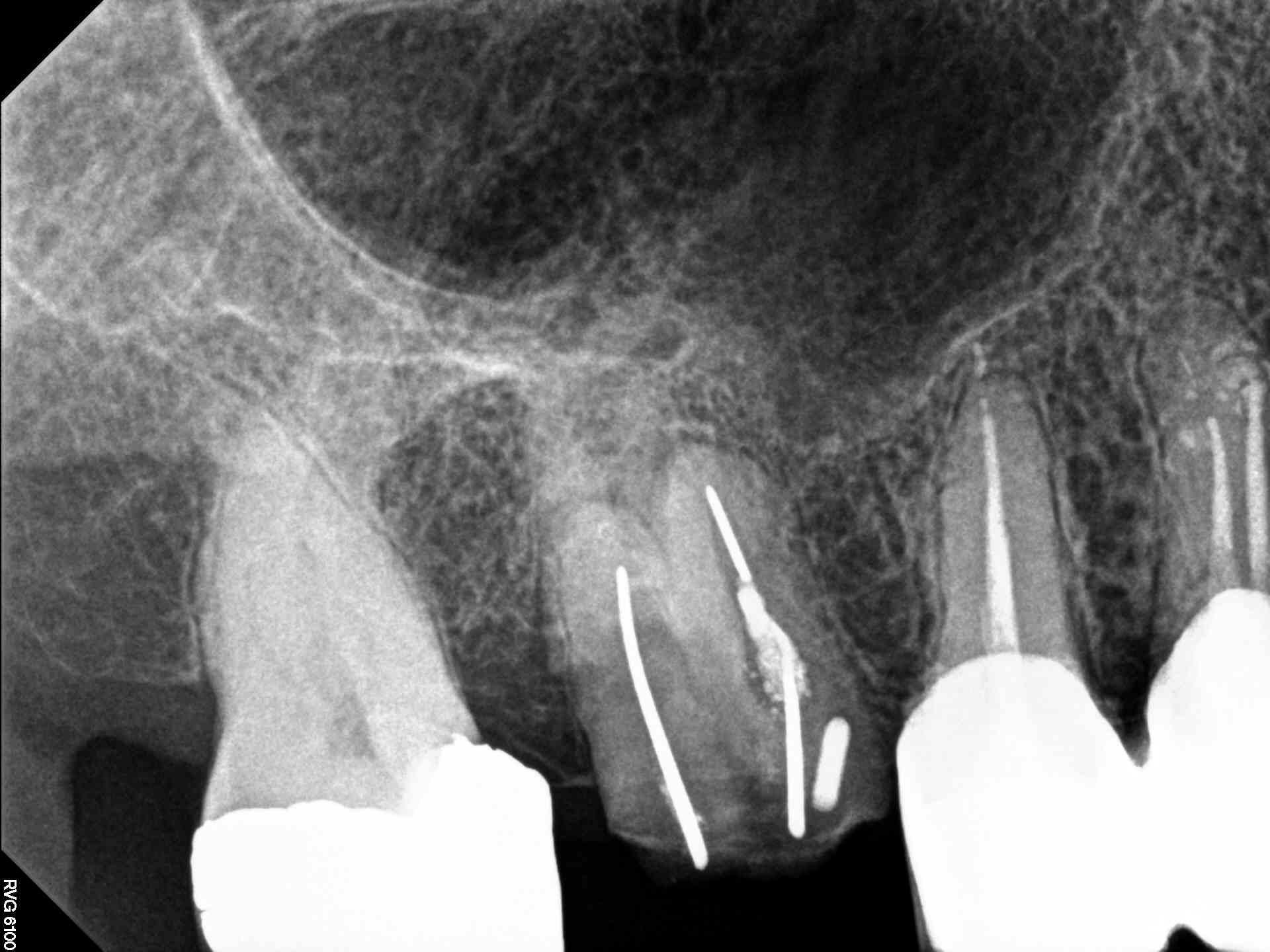 Root Canal Treatment Wallpapers - Top Free Root Canal Treatment