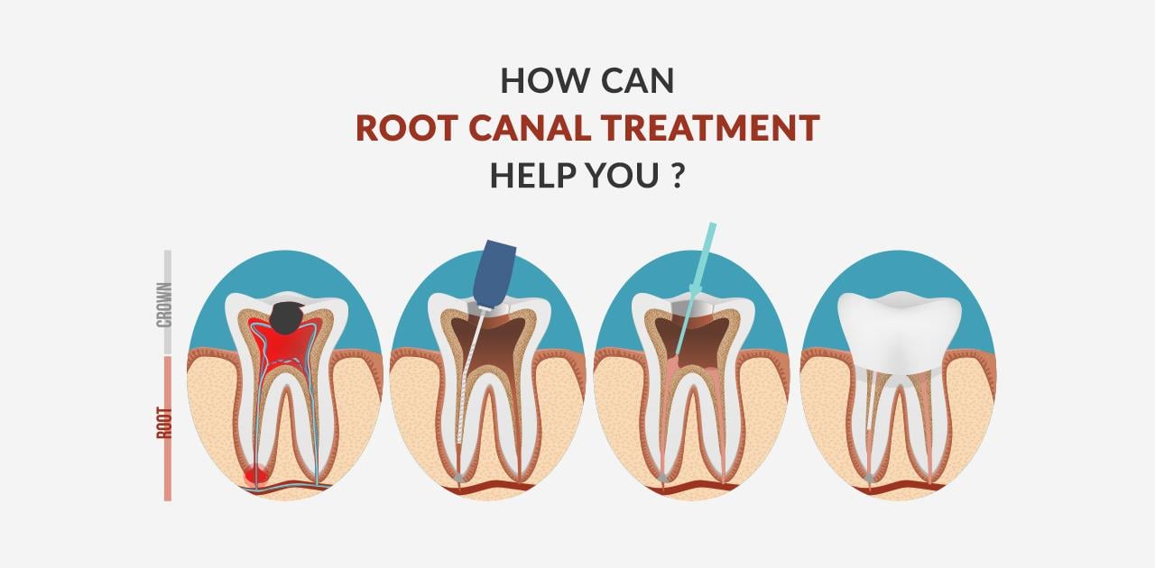 Root Canal Treatment Wallpapers Top Free Root Canal Treatment