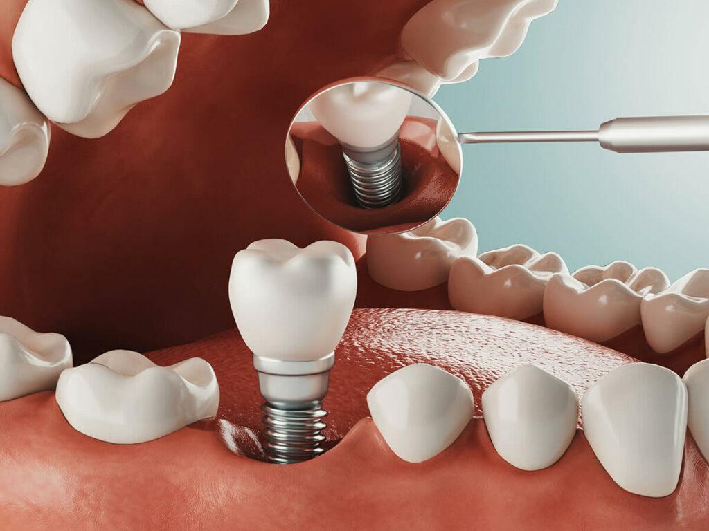 1024x768 Dental Implants in Katy, TX Peek Dental Care