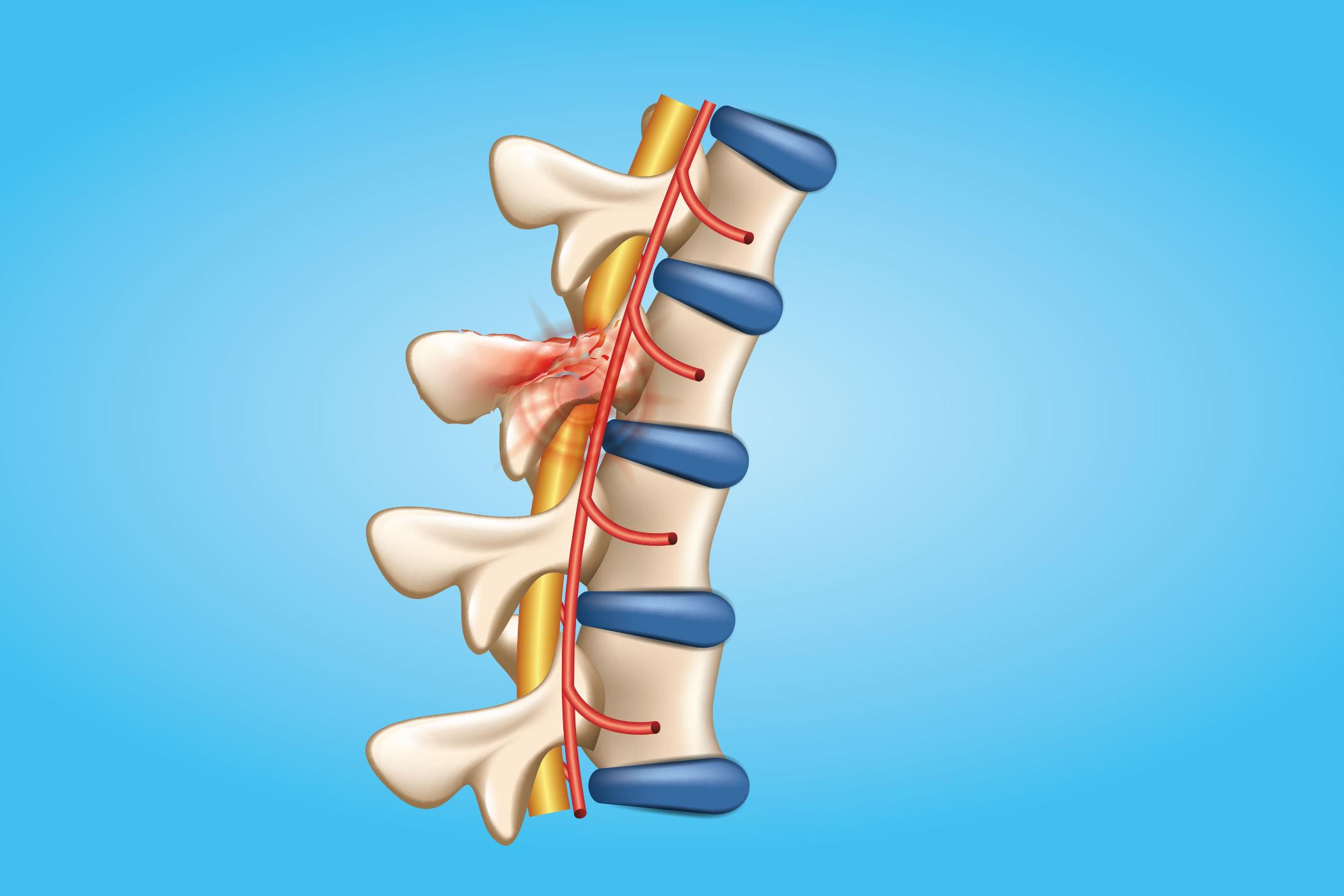 2100x1400 A Breakthrough in Spinal Cord Injuries